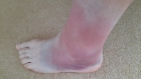 This is what can happen when you roll your ankle. A month injured, not running!